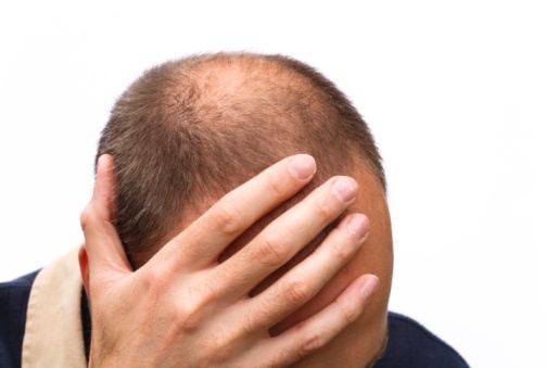 Could your receding hairline be a sign of cancer?