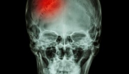 Concussions may cause stroke in the future