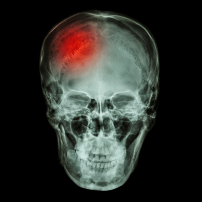 Concussions may cause stroke in the future