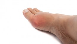 What you need to know about gout