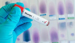 University of Illinois at center of mumps outbreak