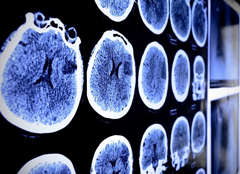 The surprising truth about stroke among young adults