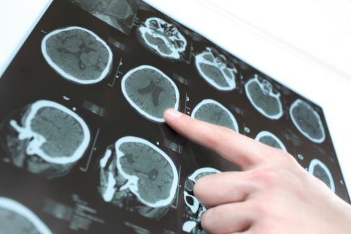 What’s it like recovering from a stroke?