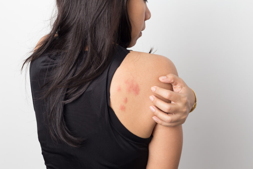 Can this painful rash be triggered by stress?