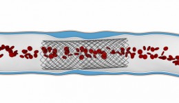 Abbott lands FDA Approval for heart stent