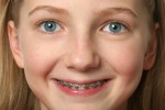 Bracing kids for orthodontic duties means greater success