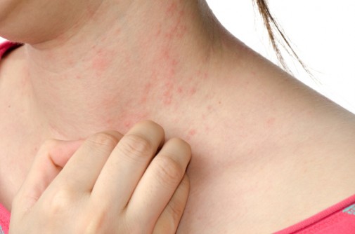 Is it a rash or psoriasis?