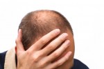 Could your receding hairline be a sign of prostate cancer?