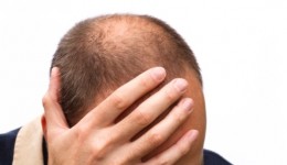 Could your receding hairline be a sign of cancer?