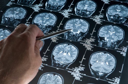 Alzheimer’s patients can now get treatment earlier