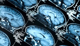 Brain aneurysm: A race to live