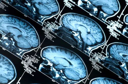 Brain aneurysm: A race to live