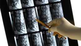 The 411 on scoliosis