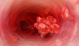 Are you at risk for deep vein thrombosis?