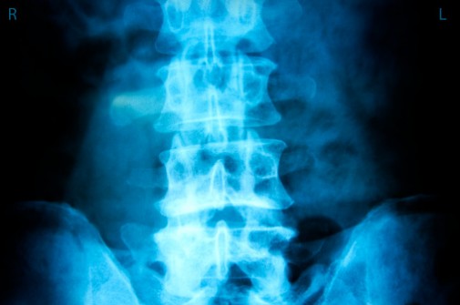 Do herniated discs always need surgery?