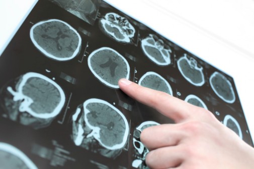 New guidelines may help prevent repeat strokes