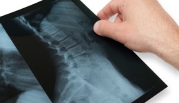 European scoliosis treatment getting attention in U.S.