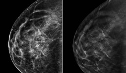 3D mammography proves highly effective in detecting breast cancer