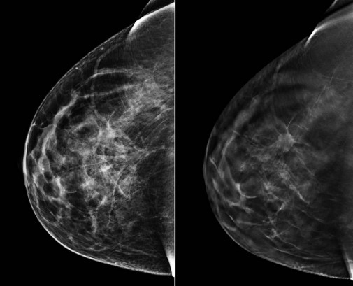 3D mammography proves highly effective in detecting breast cancer