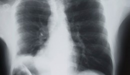 Overall lung cancer rates dropping in U.S.