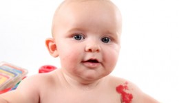 Is your child’s birthmark cause for concern?