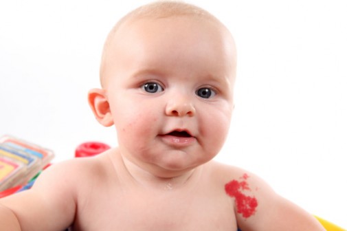 Is your child’s birthmark cause for concern?