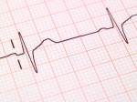 Eighty percent of heart attacks in men may be preventable