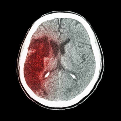 Stroke myths debunked