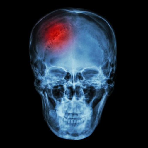Are highly educated people at increased risk for stroke?