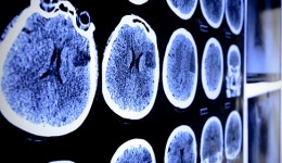 Can changes in behavior predict Alzheimer’s?