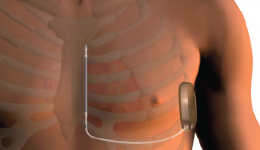 Skin deep device gives a life-saving jolt to the heart