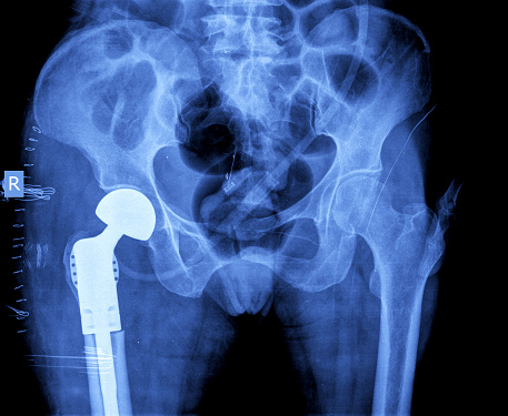 Hip replacements aren’t just for seniors