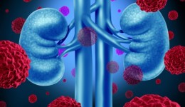 What you need to know about kidney cancer