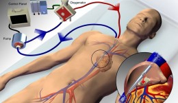Rare heart procedure saves man’s life
