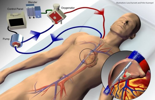 Rare heart procedure saves man’s life