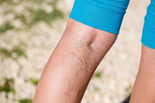 Say goodbye to varicose veins