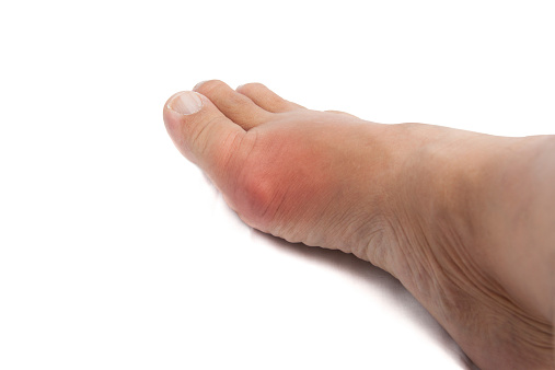 What you need to know about gout | health enews