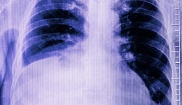 Smokers not the only ones at risk for COPD