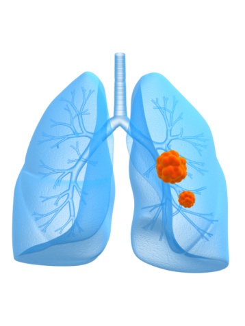 Lung screenings save lives