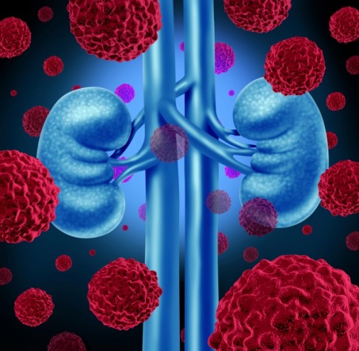 Are you at risk for chronic kidney disease?