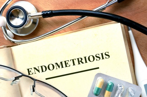 What young women should know about endometriosis