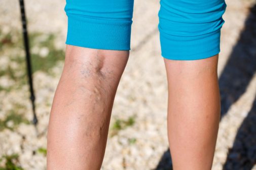 Finding relief from varicose veins