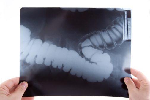 Colon cancer screening: As easy as swallowing a pill?