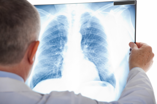 5 myths about lung cancer