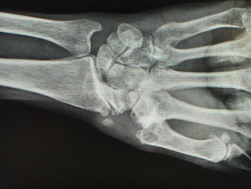 Wrist pain? Here’s why you may want to consider surgery