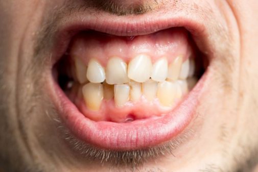 Crooked teeth? They could hurt more than just your self-esteem