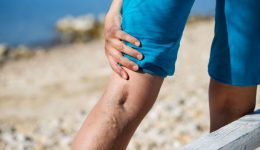 Finding relief from varicose veins