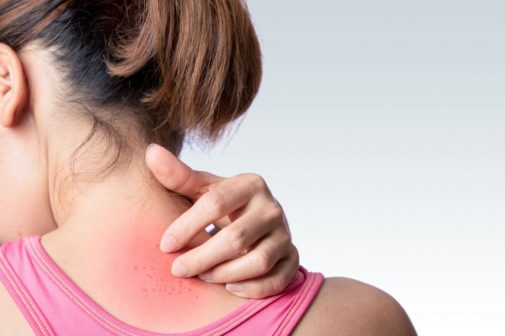 This skin irritation is common in hot weather