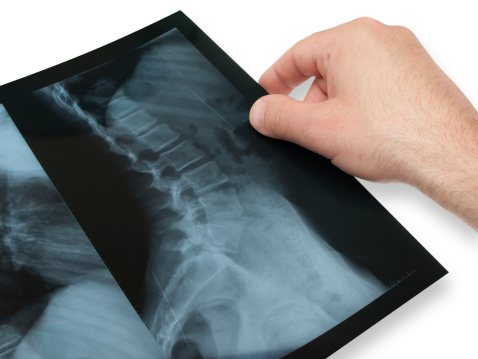 Things to know about a scoliosis diagnosis