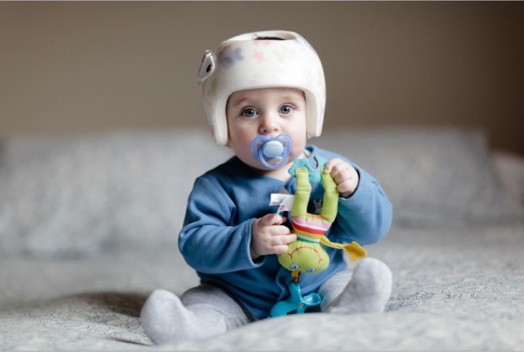 Does your baby need a helmet? health enews